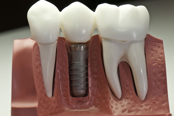 Имплантация зубов и костная пластика